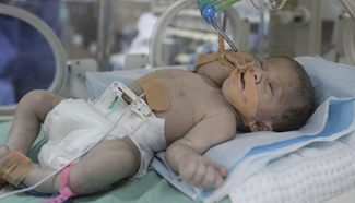 Rare dicephalic twins born in Gaza