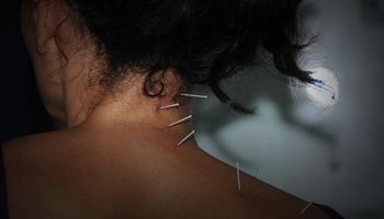 Patients receive Chinese acupuncture treatment around the world