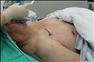 11:28 植入電極後，開始為楊先生埋電池。腦部的電極需要通過皮下導線與植入在胸部皮下的刺激發生器（電池）連接，楊先生有胸部劃線的位置即為電池植入處。
