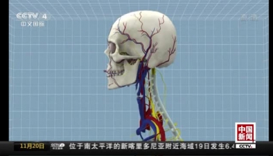 世界首例遺體“換頭術”完成：三維動畫展示“換頭術”如何進行