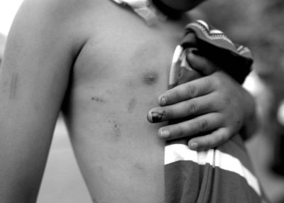 孩子的手指和上身有多处伤疤。