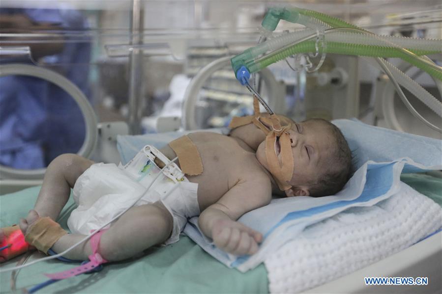 MIDEAST-GAZA-CONJOINED TWINS