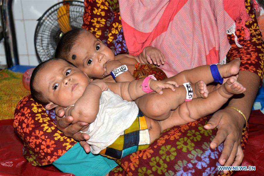 BANGLADESH-DHAKA-CONJOINED TWINS