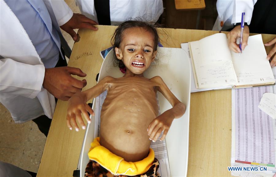 YEMEN-SANAA-CHILDREN-MALNUTRITION
