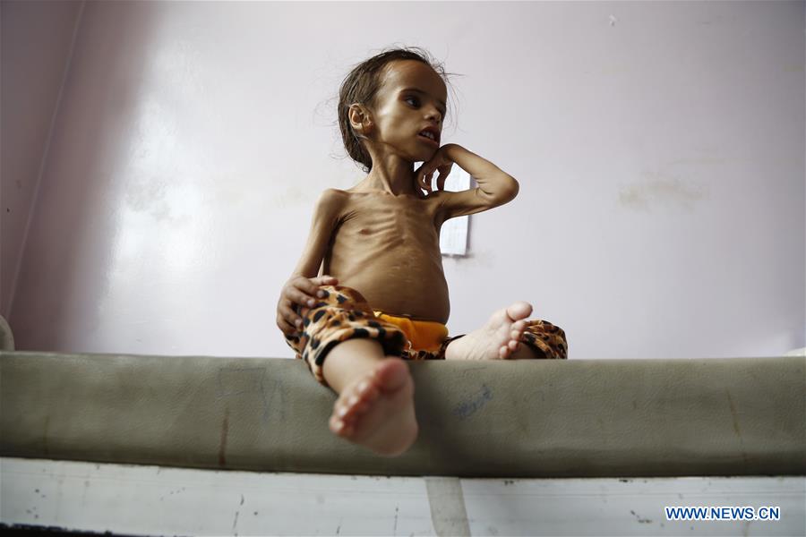 YEMEN-SANAA-CHILDREN-MALNUTRITION