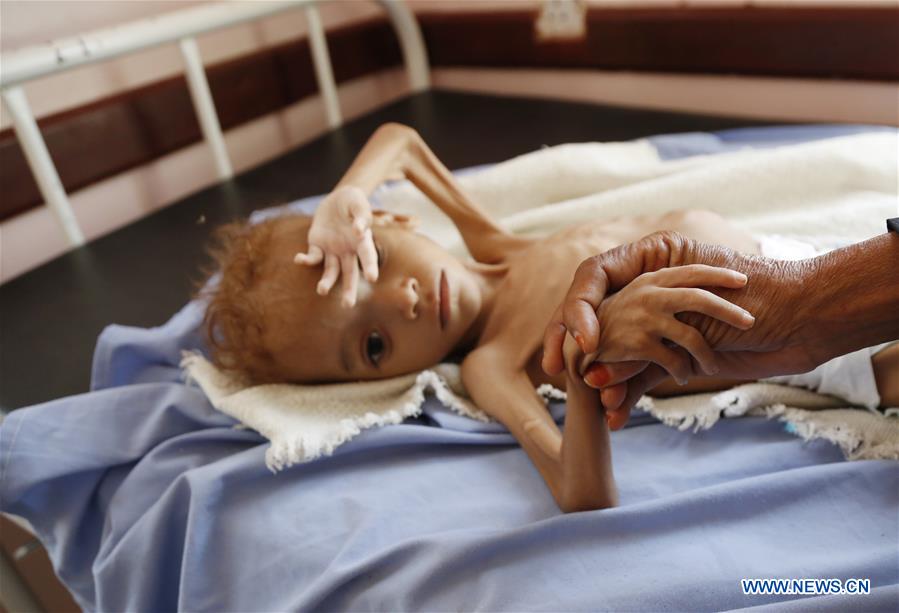 YEMEN-HAJJAH PROVINCE-FAMINE-CHILDREN