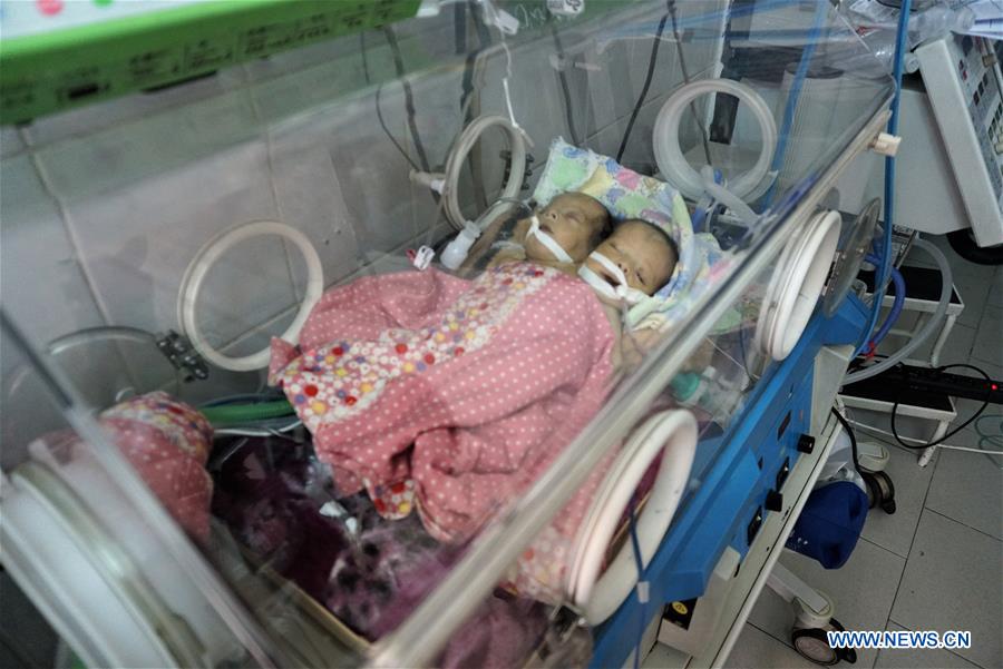 YEMEN-SANAA-CONJOINED TWINS-DEATH