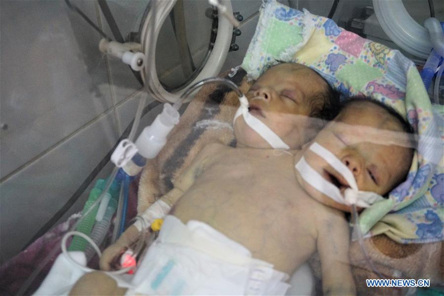 YEMEN-SANAA-CONJOINED TWINS-DEATH