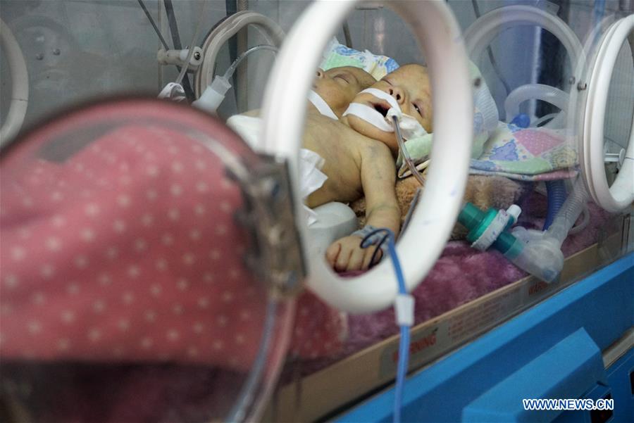 YEMEN-SANAA-CONJOINED TWINS-DEATH