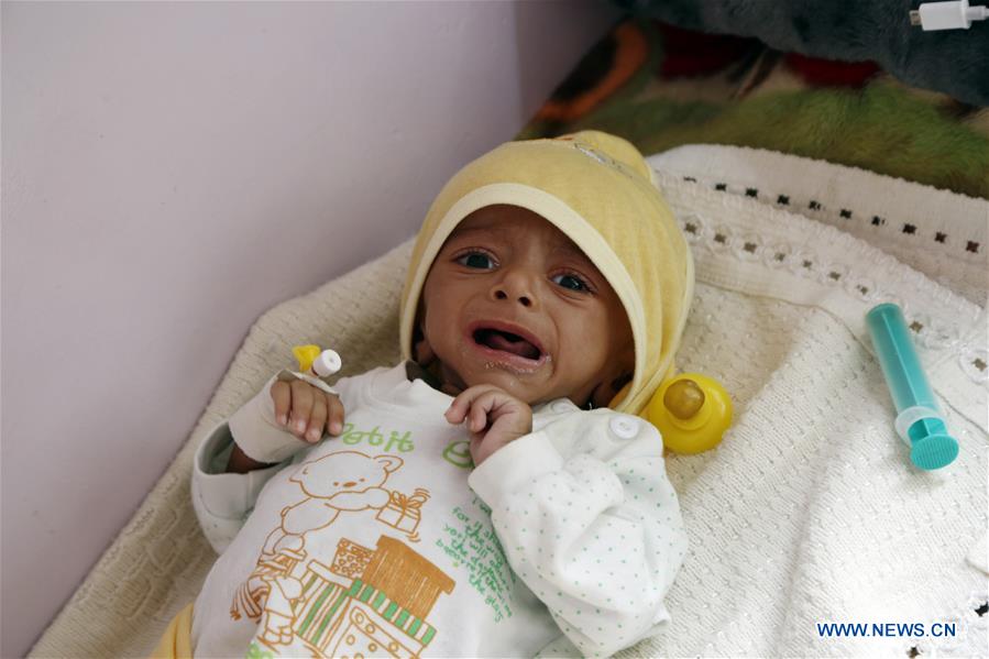YEMEN-SANAA-CHILDREN-MALNUTRITION