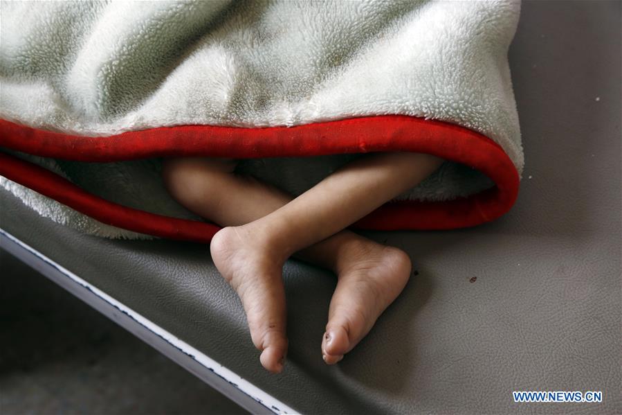 YEMEN-SANAA-CHILDREN-MALNUTRITION