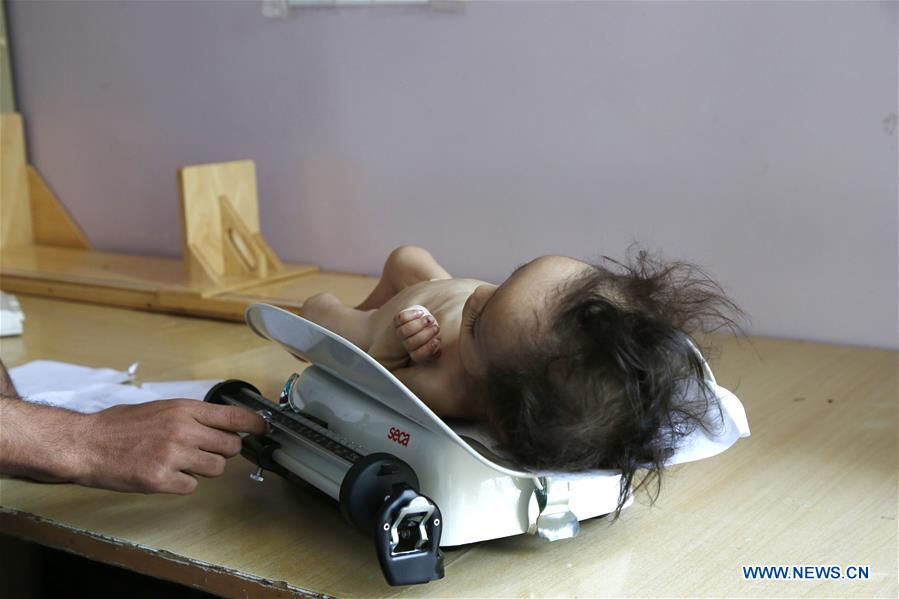 YEMEN-SANAA-CHILDREN-MALNUTRITION