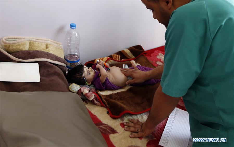 YEMEN-SANAA-CHILDREN-MALNUTRITION