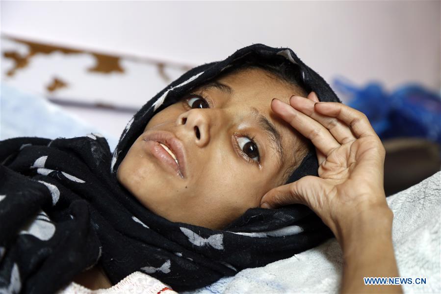 YEMEN-SANAA-HUNGER-CHILDREN