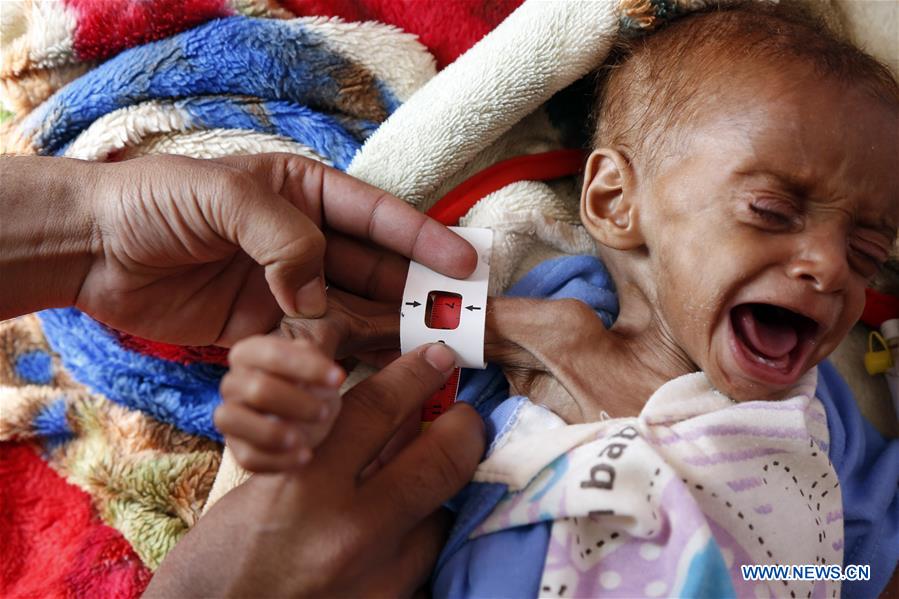 YEMEN-SANAA-CHILDREN-MALNUTRITION