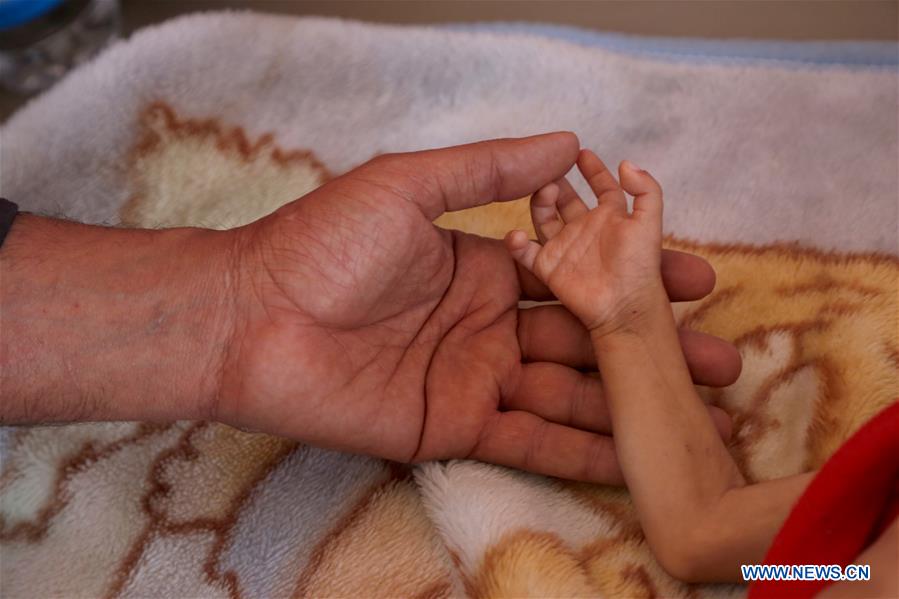 YEMEN-SANAA-MALNUTRITION-CHILDREN