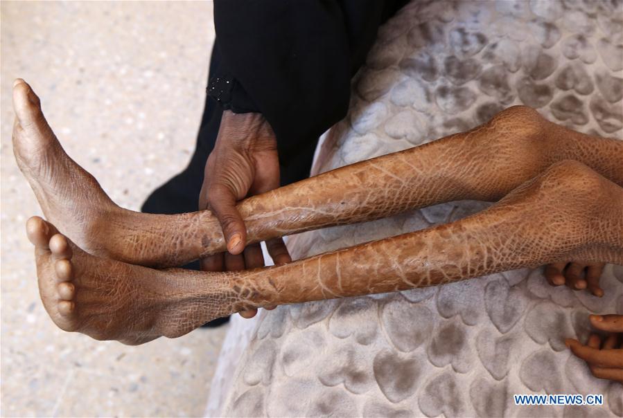 YEMEN-SANAA-CHILDREN-MALNUTRITION