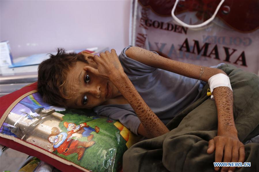 YEMEN-SANAA-CHILDREN-MALNUTRITION
