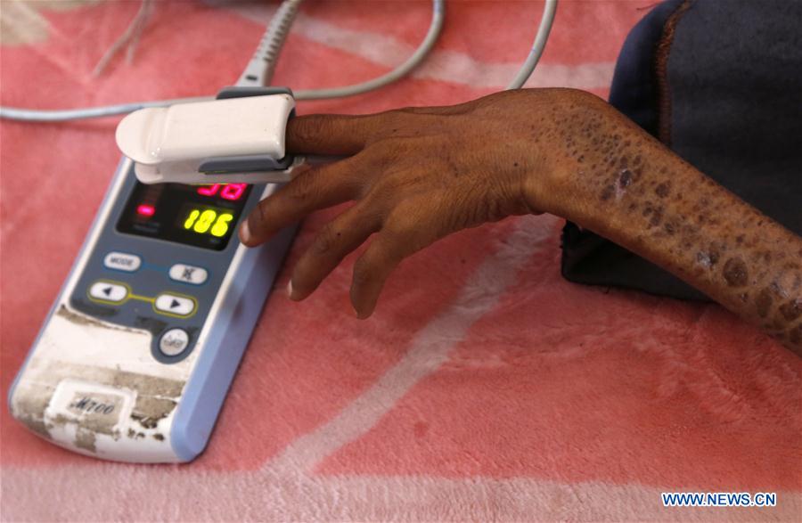 YEMEN-SANAA-CHILDREN-MALNUTRITION