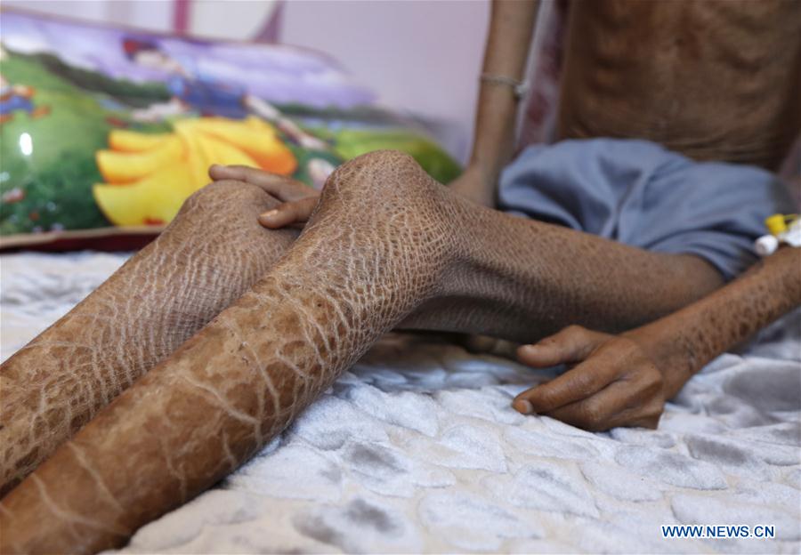 YEMEN-SANAA-CHILDREN-MALNUTRITION