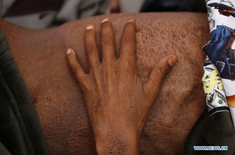 YEMEN-SANAA-CHILDREN-MALNUTRITION