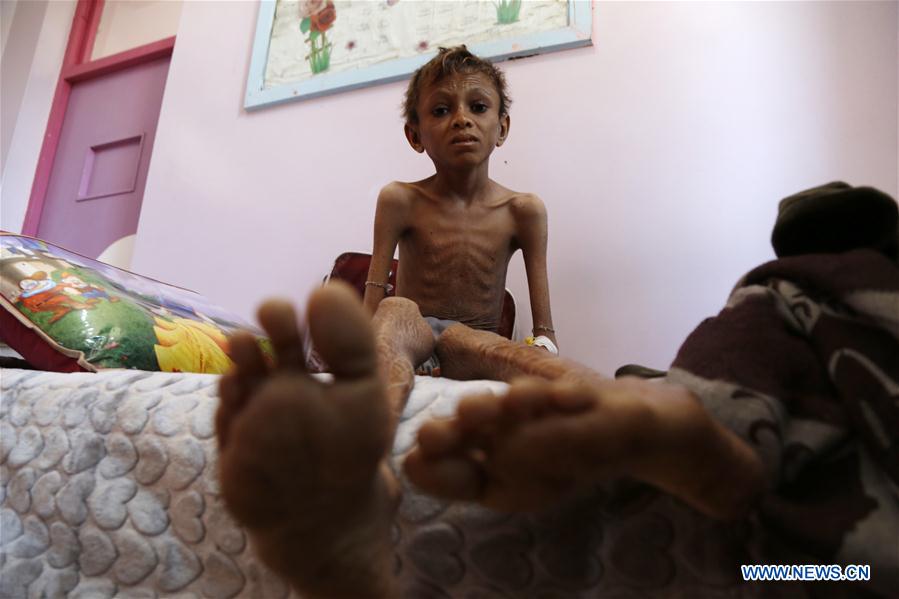 YEMEN-SANAA-CHILDREN-MALNUTRITION