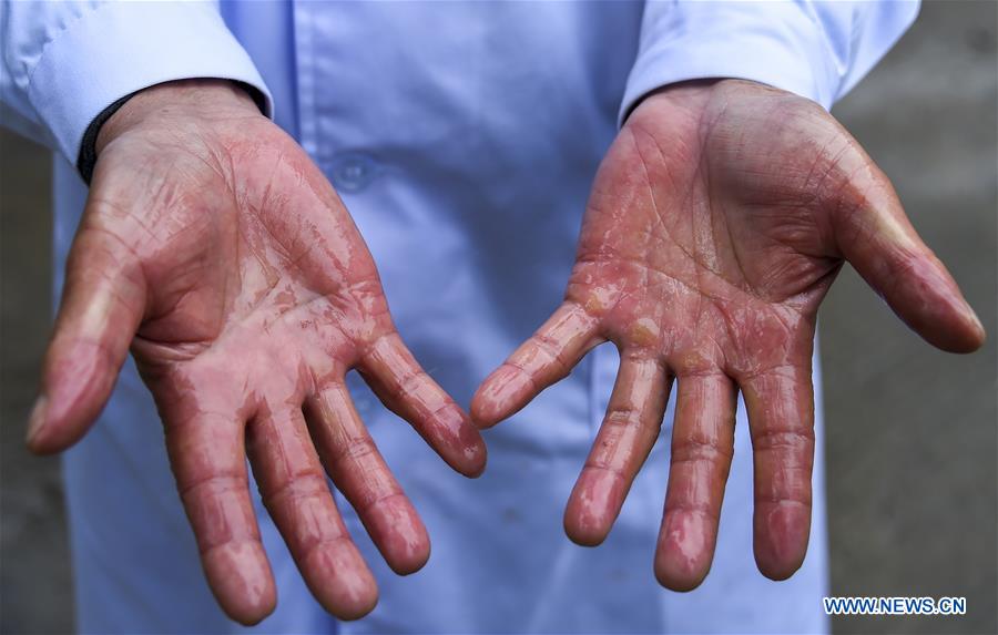 CHINA-HUBEI-XIAOGAN-SANITATION WORKERS IN HOSPITALS (CN)