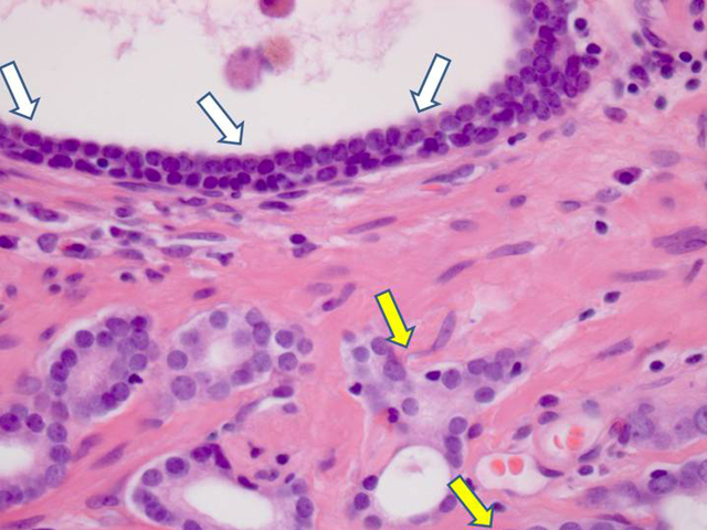 'Chameleon cells' in blood cause metastasis - Italian study Isolated, 'basis for diagnosis and treatment'