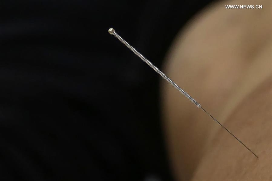 CHINA-TRADITIONAL MEDICINE-ACUPUNCTURE THERAPY (CN)