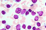 Leukaemia