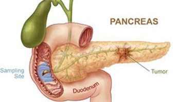 Australian boy fitted with artificial pancreas in world first