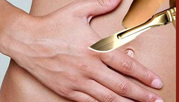 Mosquito nets safe to use in groin hernia repair: study