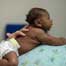 Zika babies may develop microcephaly months after birth