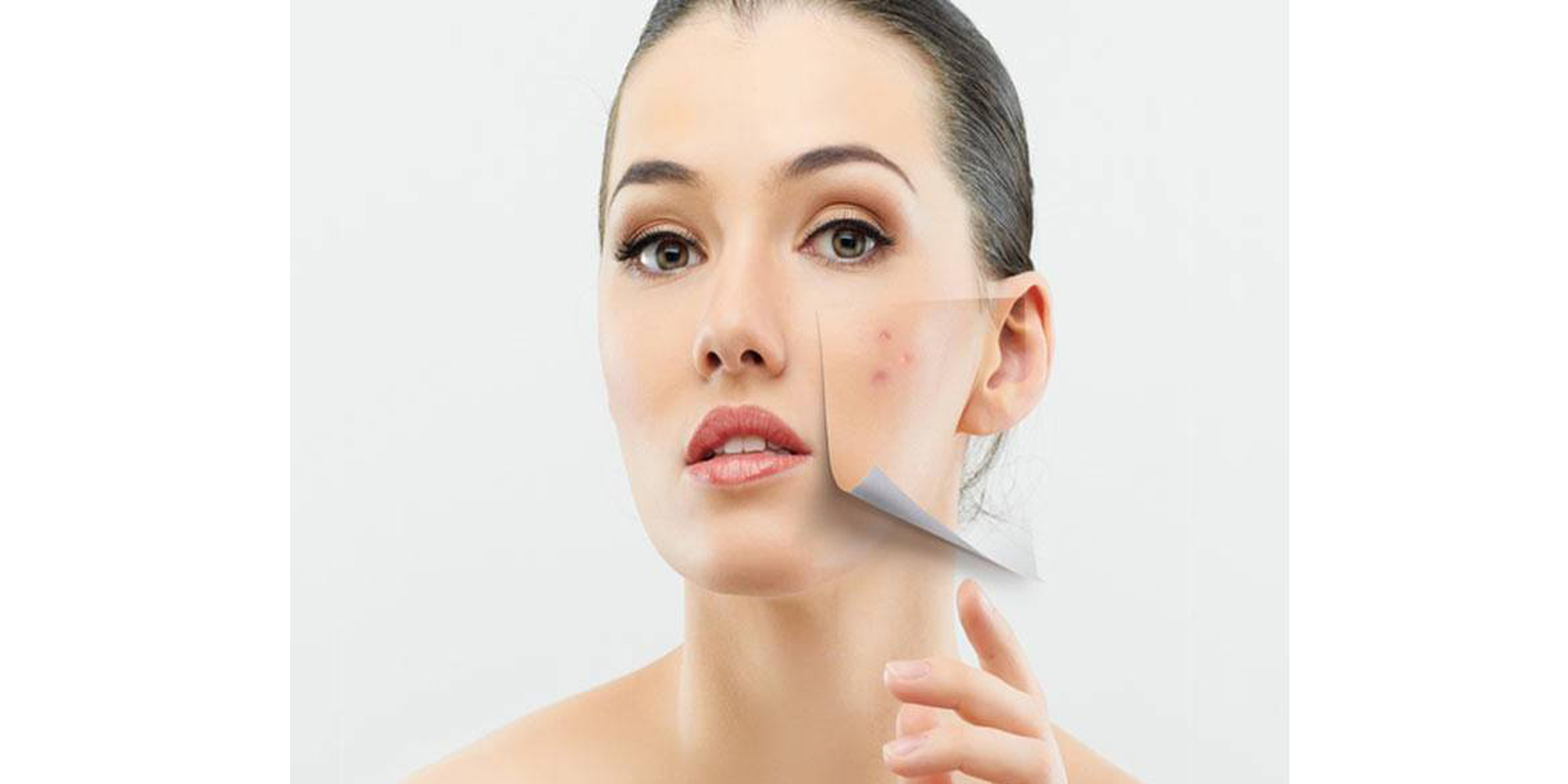 挑选防晒霜之痘痘皮肤