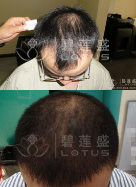 植发前后对比效果