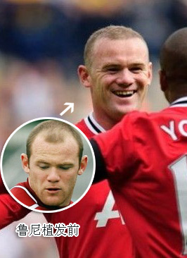 明星植发前后效果对比