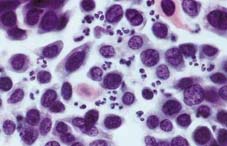 什么是慢性肾脏病 当心不知不觉的肾损伤