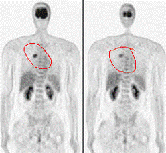 CTC肿瘤细胞免疫治疗他打赢了肺癌保卫战