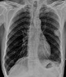 CTC肿瘤细胞免疫治疗给肺癌的他带来生命的&ldquo;春天&rdquo;