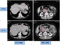 生物疗法成功治愈胰腺癌合并肝转移骨转移患者
