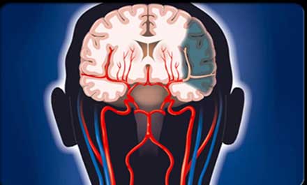 高危人群注意颈动脉筛查