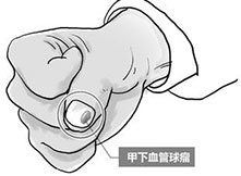 这种病的痛感就像每天用针插进指甲缝