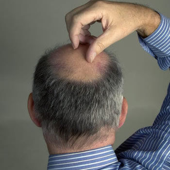 揭秘导致谢顶的坏习惯