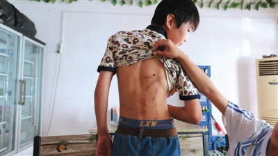 小刚（化名）被殴打后，脸部和身上留下多处伤痕。