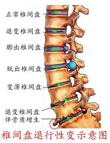 军医科普:如何减缓腰椎老化进程