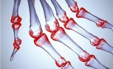 军医科普:不死的癌症 类风湿关节炎