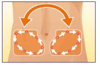 军医提醒:胰岛素注射有讲究