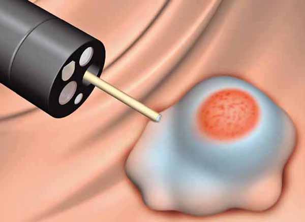 令狐恩强:消化系统疾病的内镜诊治