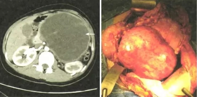 军医提醒:胃肠不适?警惕七大结缔组织病