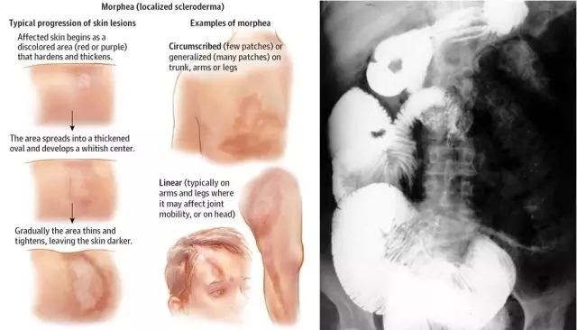 军医提醒:胃肠不适?警惕七大结缔组织病
